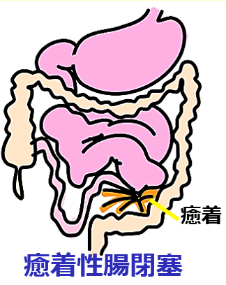 small bowel obstruction